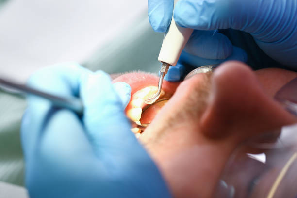 Best Knocked-Out Tooth (Avulsed Tooth) Treatment in Fort Branch, IN